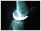 MAKO Post-op X-ray
