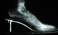 Safer heel x-ray